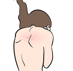 背中ニキビの特徴